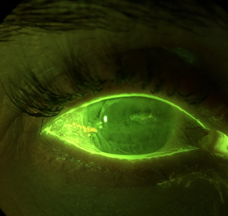 New treatment for severe corneal inflammation from dry eye disease now ...